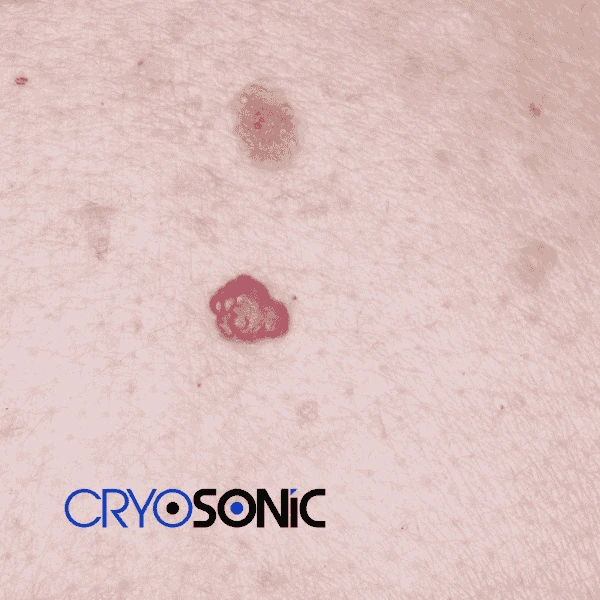 Looking for pain free cherry angioma removal treatment Woking? Call our team today! Woking