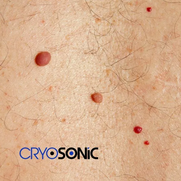get cherry angioma removal treatment today! Woking