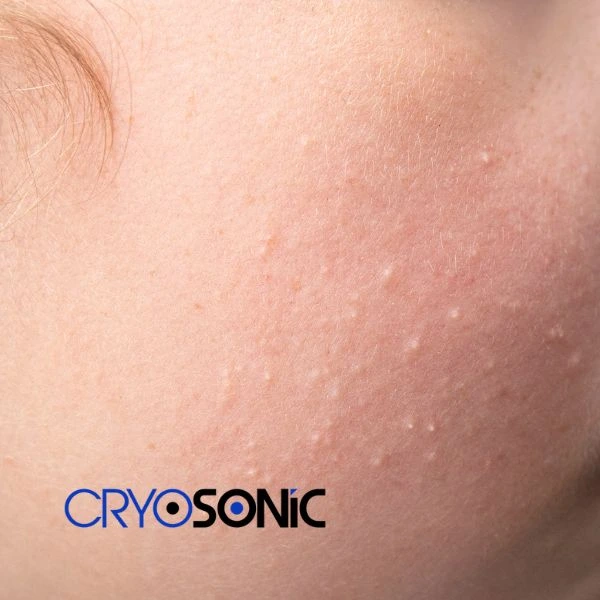 Are you looking for milia removal treatment? Contact our team today Woking