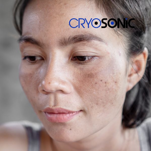 Ready to start age spots removal? Contact our team today in Woking