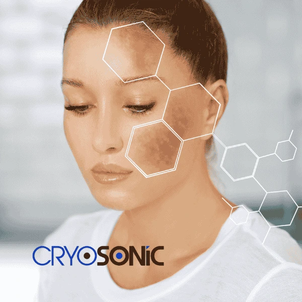 Are you looking for age spot removal treatment? Contact Cryosonic today in Woking