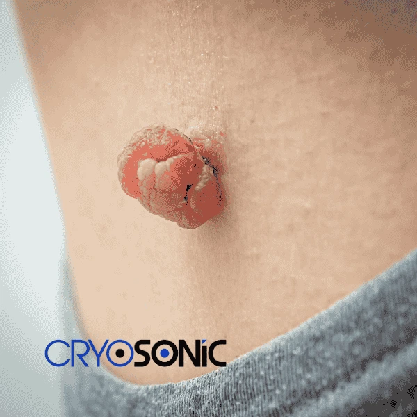 Book your skin tags removal Woking from comfort of your own home! Woking
