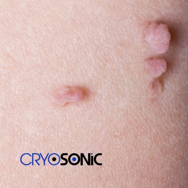 Are you looking for fast effect skin tag removal Woking? Book in NOW! Woking