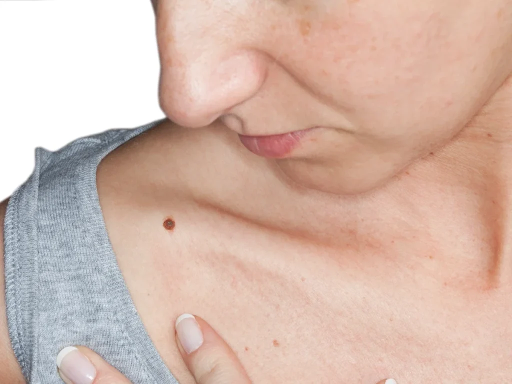 How Does CryoPen Sun Damage Treatment Woking Work? Woking