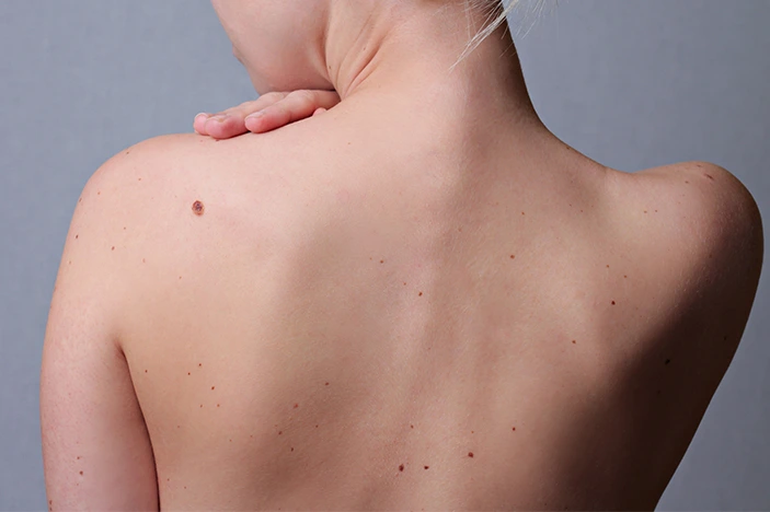 The Skin’s Healing Journey After CryoPen Sun Damage Treatment Woking