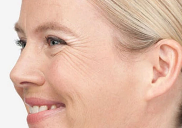 CryoPen Precision vs. Laser: Which Is Better for Sun-Damaged Skin? Woking