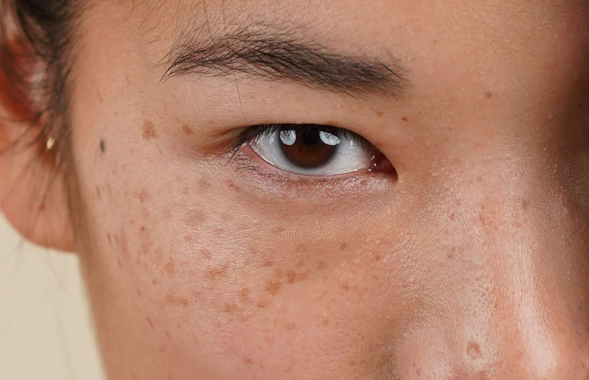 Is There Any Risk of Scarring or Pigmentation Woking? Woking