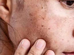 Why CryoPen Works Best for Isolated Sun Spots and Pigmentation Woking